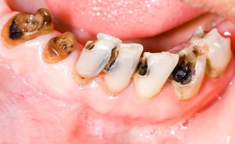 Răng đau có thể do nhiều nguyên nhân khác nhau gây ra và mỗi nguyên nhân sẽ gây nên những triệu chứng khác nhau