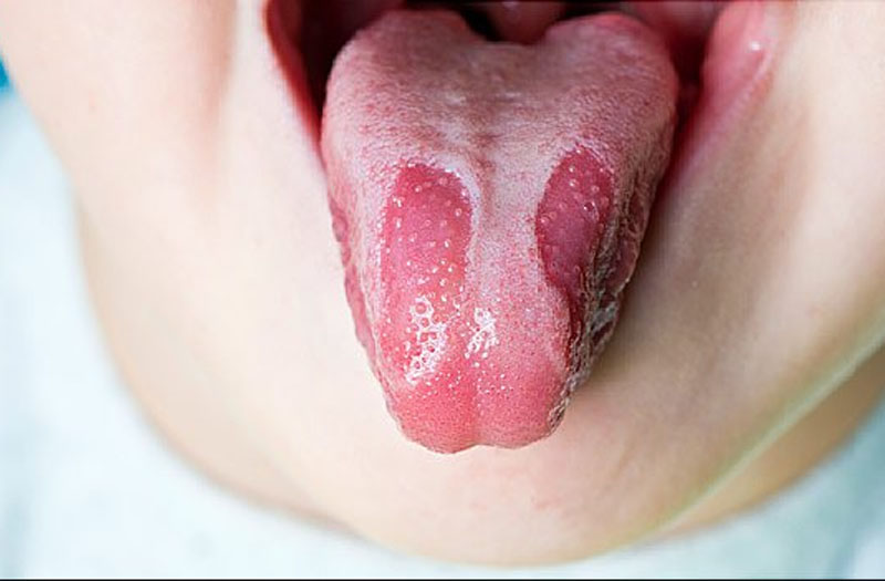 Tổng hợp] Cách chữa nấm lưỡi tận gốc cho mọi đối tượng bạn cần biết