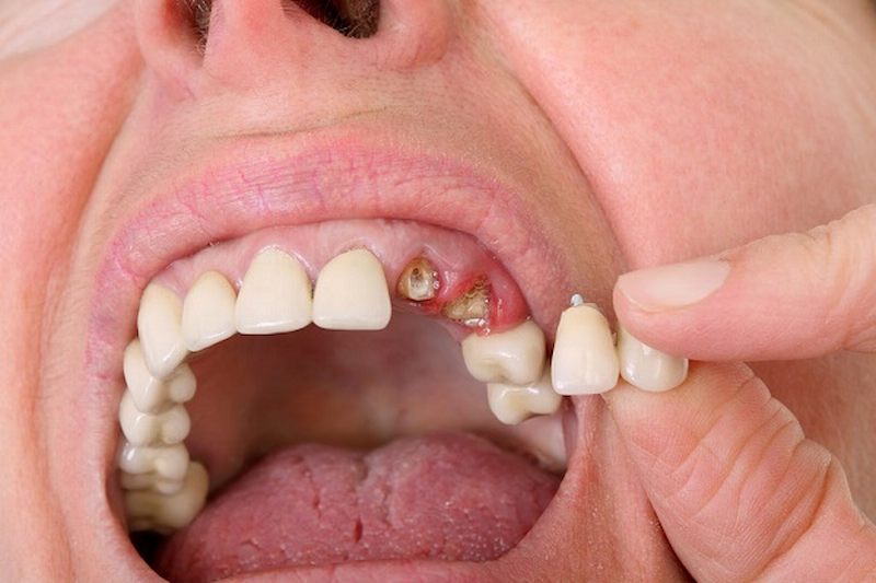 Nếu không điều trị, người bệnh có thể gặp phải biến chứng mất răng